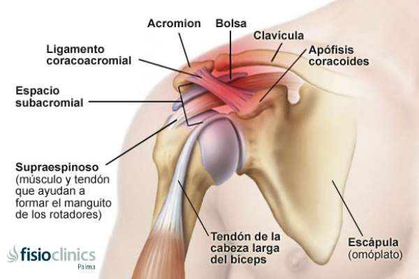 Dolor de Hombro Palma Dolor de Hombro Palma