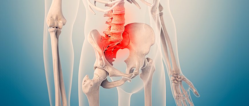 Conoce En Qué Consiste La Sacroileítis Fisioclinics 3064