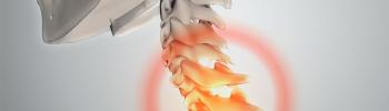 Hernia discal cervical - FisioClinics Palma