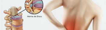 Hernia discal lumbar. Síntomas y causas