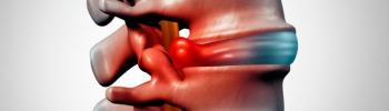 ¿Cuáles son los síntomas de una Hernia discal?