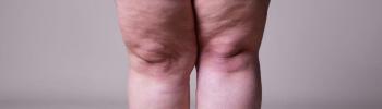 Lipedema piernas