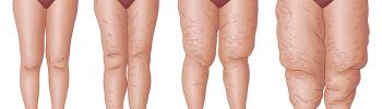Diagnóstico de Lipedema en Bilbao