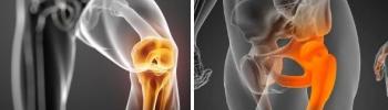 Artrosis de cadera y rodilla ¿En qué consiste?