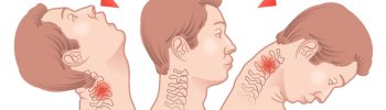 latigazo cervical