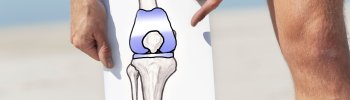 Prevención de la artrosis de rodilla a través de la fisioterapia
