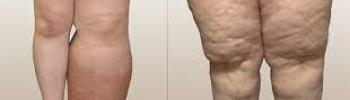 Linfedema y Lipedema: Diferencias y Similitudes en su Tratamiento