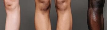 Dolor en la parte interna de la rodilla: abordaje de la tendinitis de pata de ganso