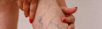 Fisioterapia vascular: Cómo prevenir complicaciones tras una trombosis