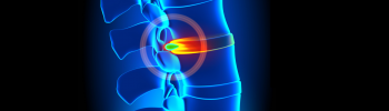 hernia discal