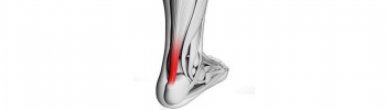 tendinitis aquilea