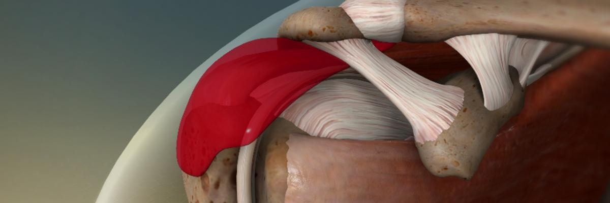 Bursitis del hombro y su tratamiento fisioterapéutico en FisioClinics Palma