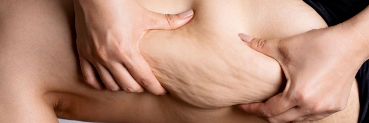 Cómo la fisioterapia ayuda a mejorar la calidad de vida en pacientes con lipedema Cómo la fisioterapia ayuda a mejorar la calidad de vida en pacientes con lipedema