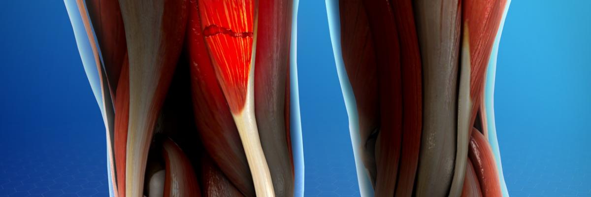 Rotura muscular de los isquiotibiales - Palma