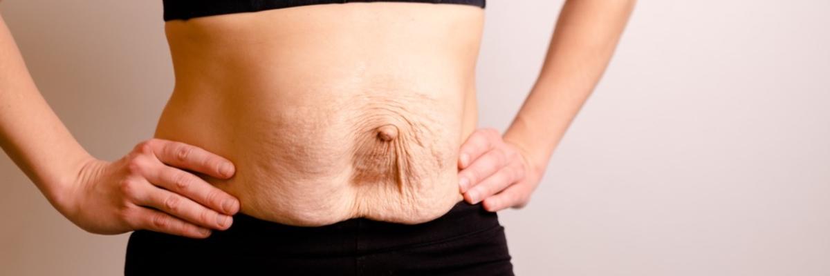 Tratamiento de la diástasis abdominal: abordaje progresivo para mejorar el abdomen
