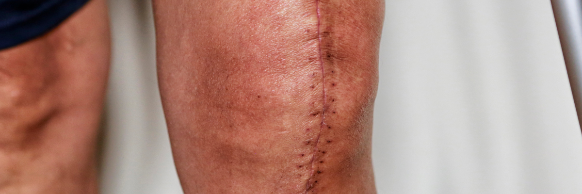 Fisioterapia postoperatoria para rotura de menisco