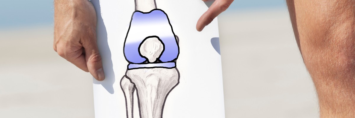 Prevención de la artrosis de rodilla a través de la fisioterapia