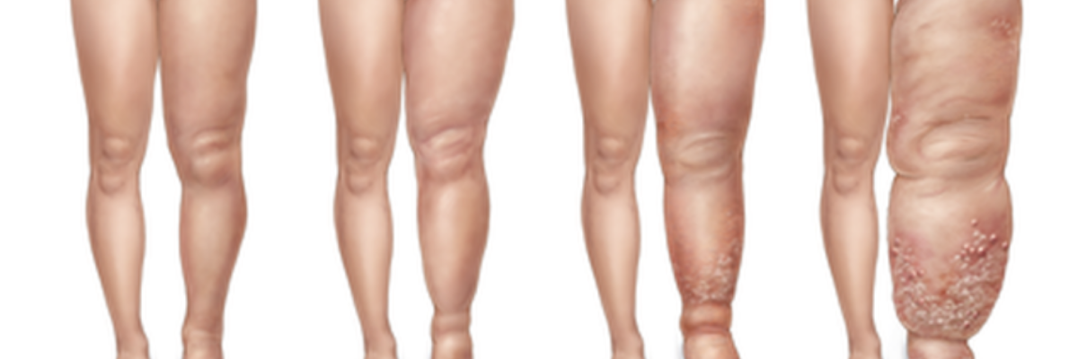 Diagnóstico de Linfedema en Bilbao