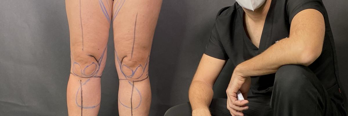 cirugía lipedema Bilbao