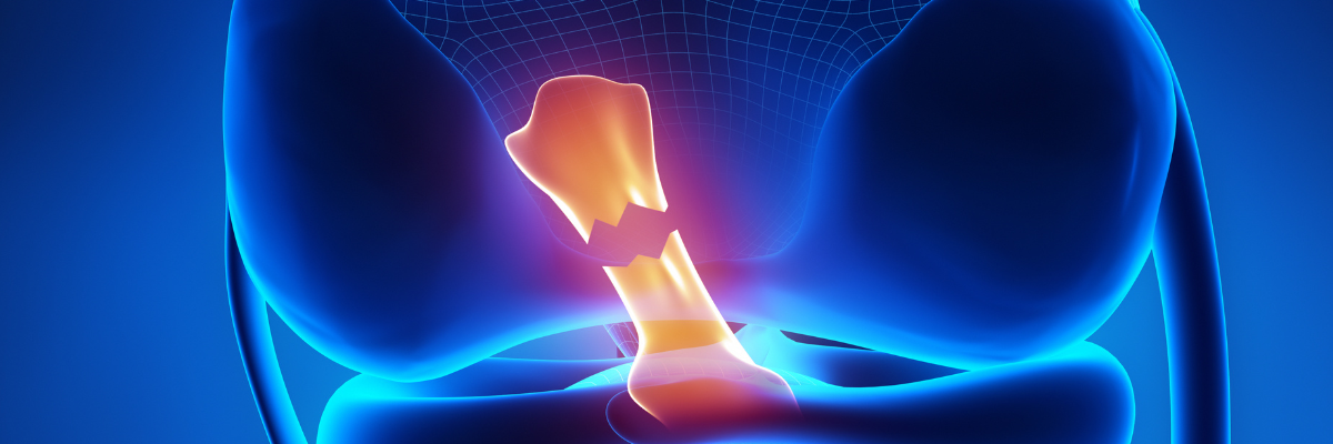 Protocolo de fisioterapia para la rehabilitación de una rotura de ligamentos cruzados