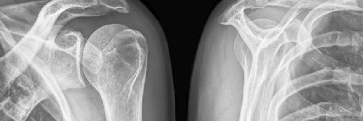 Estiramientos para el síndrome subacromial y prevención de tendinitis