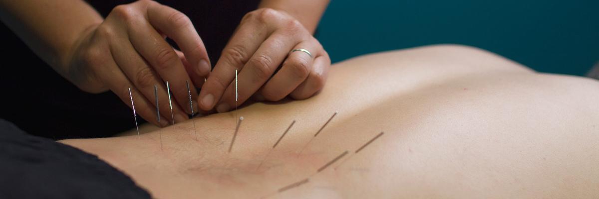 Todo lo que Debes Saber sobre la Punción Seca en la Fisioterapia